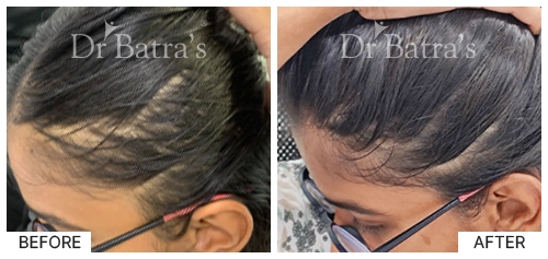 Hair Falling Treatment